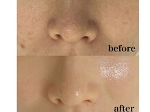 エンネ(En’ne)の雰囲気（セラピールのビフォーアフターです。美肌革命♪）