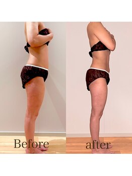 スリラ(SuriLa)/◆ビフォーアフター◆