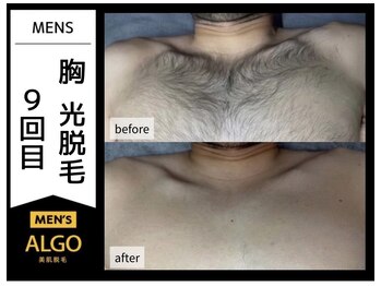 アルゴ 福井店(ALGO)/服からはみ出す胸毛も撃退！