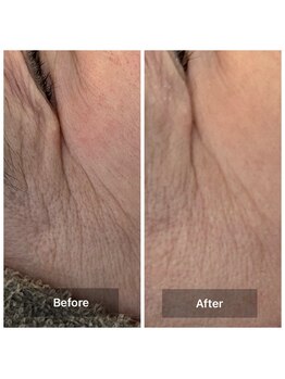 ルミエール(Lumiere)/７０代女性　目尻のシワケア