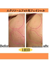 パルティノ 高崎店/エクソソーム光フェイシャル