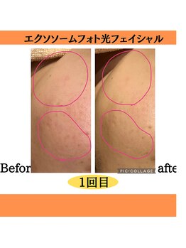 パルティノ 高崎店/エクソソーム光フェイシャル