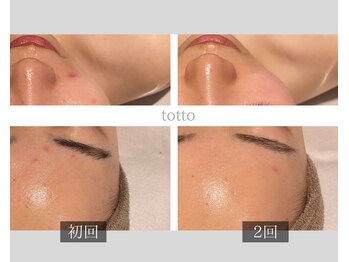 サロントット(salon totto)/before→after　ニキビケア