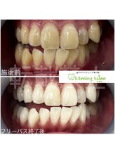 ホワイトニングサロン 札幌店/【ホワイトニング】#札幌#大通り