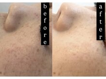 クロア ナゴヤ(Croire NAGOYA)/ビフォーアフター/光フォト