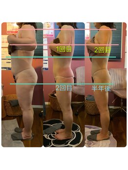 レイ 本厚木(Rei)/脂肪冷却ビフォーアフター写真