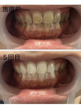 ホワイトニング専門店 スマイルホワイト/50代女性