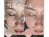 【新韓国美容/透明感革命！】水光ツヤ肌!?雪花ピール2回目以降¥13,860