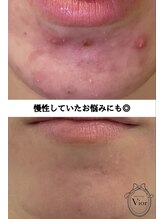 ヴィオール 名古屋栄店(VIOR) 肌悩み 徹底改善☆