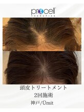 ユミト(Umit)/プロセルスカルプ