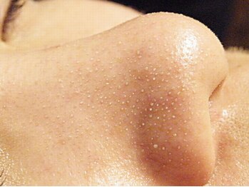 ビュップ 浜松町店(美up)/毛穴レス