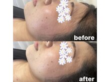 ピエール ナリタイラボ 薬院店(Piel NARITAI LABO)/一回で驚きの変化♪