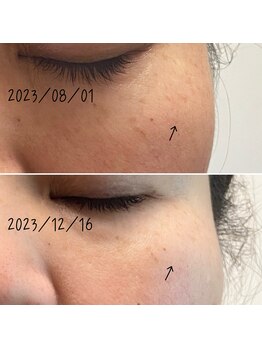 アルディート(Ardito)/ホワイトスノーピール