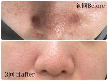 ル シェリア(Le Cherien)/ハーブピーリング