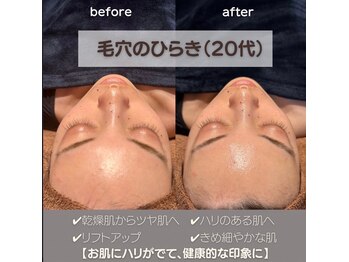 モアナ(Moana)/毛穴の開き改善