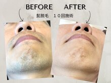 ワンアップ(One-up)/ヒゲ脱毛 １０回　before　after