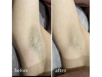 メルシー13/ワキ脱毛