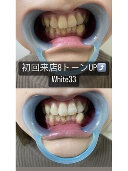 アイブロウ33 久留米店/【ホワイトニングBefore After】