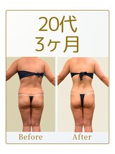 キュール(KuhL)/20代痩身ビフォーアフター☆
