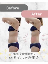 ミネット(minette)/脂肪冷却＊before→after