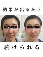 小顔矯正専門サロン キュープ 茨城つくば店(Qpu)&nbsp;小顔矯正 オイルケア