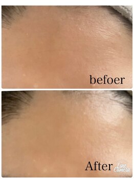 リッチベル(richbelle)/ハーブピーリング初回(額)