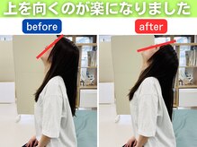 リハスル(REHASUL)/ 上を向いた時の違和感が改善！