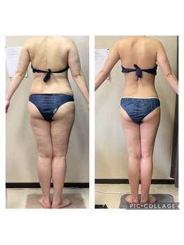 ビボディラボ 海老名店(美Body Labo)/ウエスト84.5→65.0cm(19.5cm)