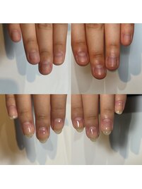 深爪のお悩みが解消する施術