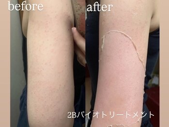 エーアール(ar)/ハーブピーリング/2Bバイオ