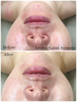 アンティミテ(Intimite)/パーソナルスキンケアコース