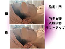 カリアンヌ/大人の毛穴ケアフェイシャル