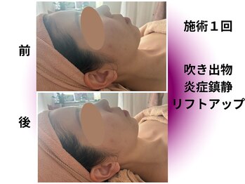 カリアンヌ/大人の毛穴ケアフェイシャル