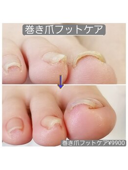 ピピ(PiPi)/【巻き爪フットケア】