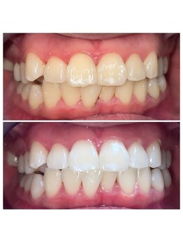 グリンプラス(grin+)/白さレベルは自分で決める