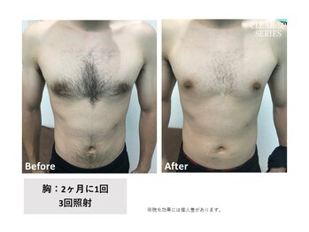 スタンド(STAND)/胸 腹脱毛 before after