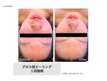 トータルクリア(TOTAL CLEAR)/Gloss肌ピーリング