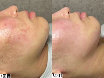 アンドミー 神戸元町店(&me)/ハーブピーリング【肌質改善】