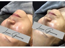 ラリマ グラマラス(Larima Glamorous)/光フェイシャル＋ジェリーマスク