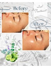 ハレル(Hareru)/Before…After(4)