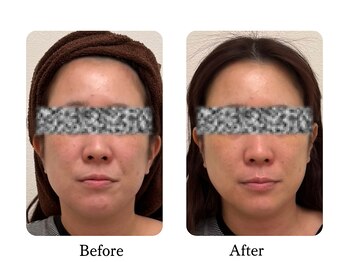 ラディアント たまプラーザ/フェイスライン、ほうれい線改善