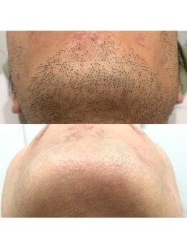 メンズサロンエヌエー(MEN'S SALON NA)/【まずはヒゲから】ヒゲ脱毛