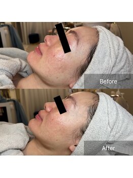 エクラルム(Eclaleum)/BeforeAfter　ララピール