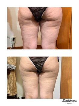 ヒーリングリゾート ナゴミ(Nagomi)/脂肪冷却◆太腿コース