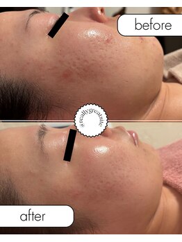 カモミール(Camomille)/肌質改善コースのお客様