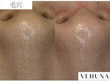 ルネア(LUNEA)/《症例》毛穴