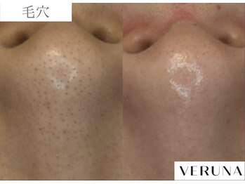 ルネア(LUNEA)/《症例》毛穴