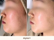 マイナプラ 表参道(myna+)/肌質改善/小顔