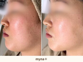 マイナプラ 表参道(myna+)/肌質改善/小顔