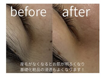 ナミル 札幌店(namir)の写真/フェイシャルワックスで産毛ゼロのムキ卵肌へ/ツルツル美肌/顔ワックス/フェイスワックス